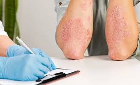 Common Psoriasis Myths