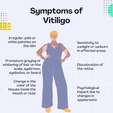 Vitiligo Awareness